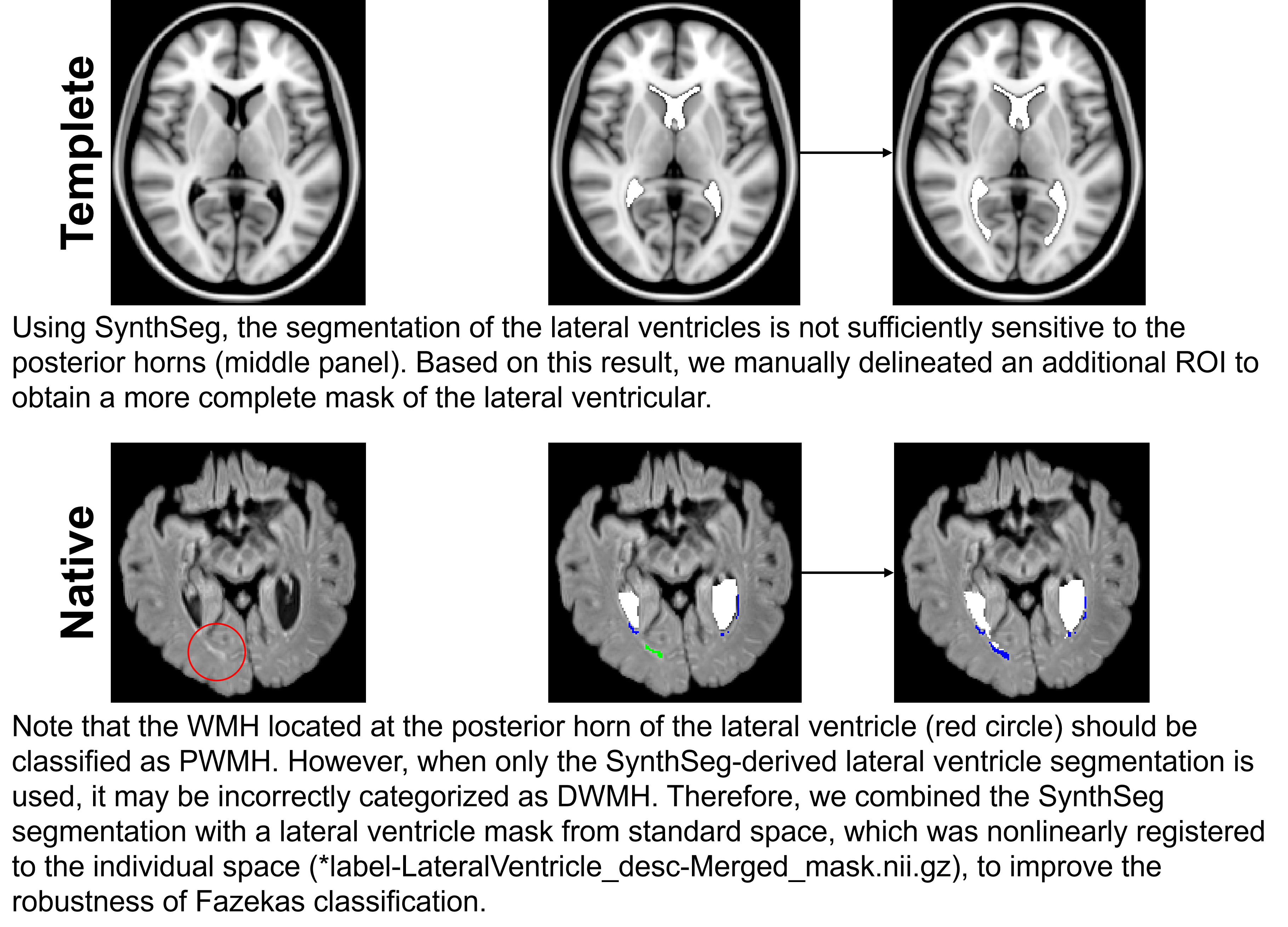 Lateral Ventricle Mask